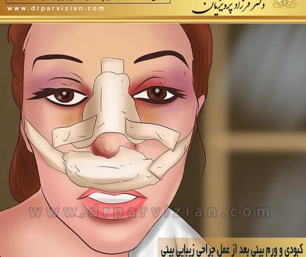 عکس روز اول عمل بینی