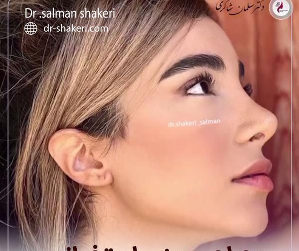 عکس روز اول عمل بینی