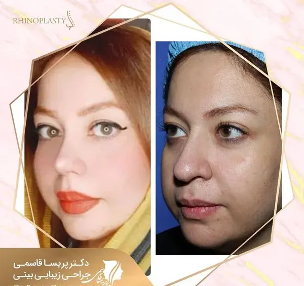 عکس روز اول عمل بینی