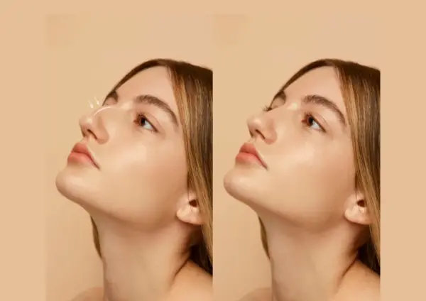 عکس روز اول عمل بینی
