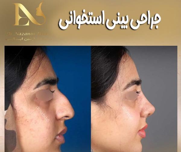 عکس روز اول عمل بینی