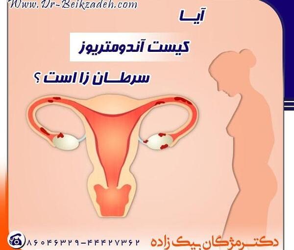 عکس بافت آندومتریوز