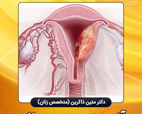 عکس بافت آندومتریوز