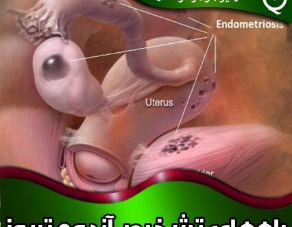 عکس بافت آندومتریوز