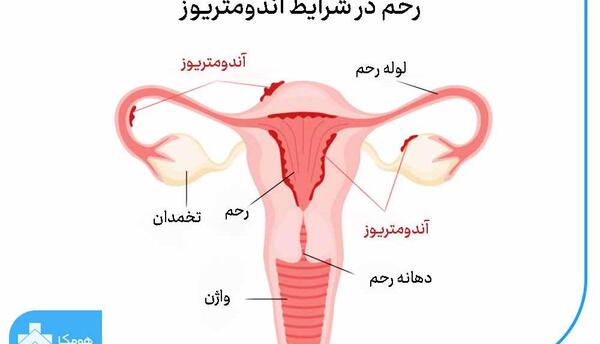 عکس بافت آندومتریوز