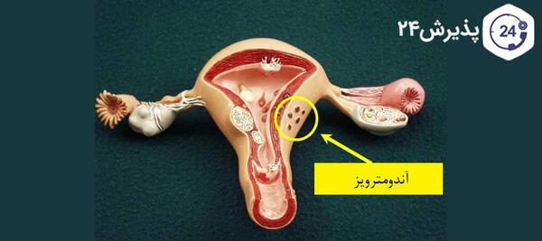 عکس بافت آندومتریوز