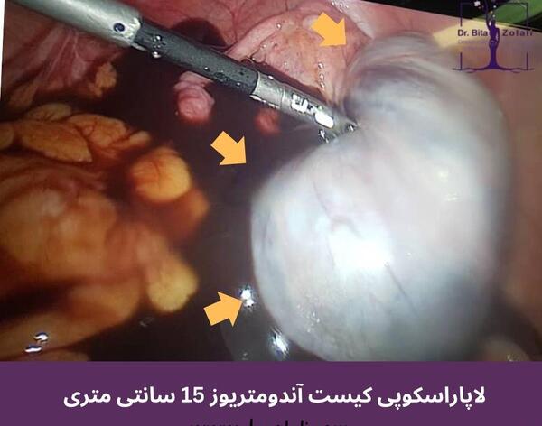 عکس بافت آندومتریوز