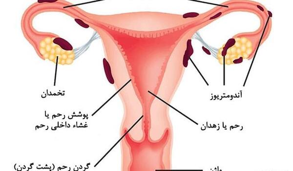 عکس بافت آندومتریوز