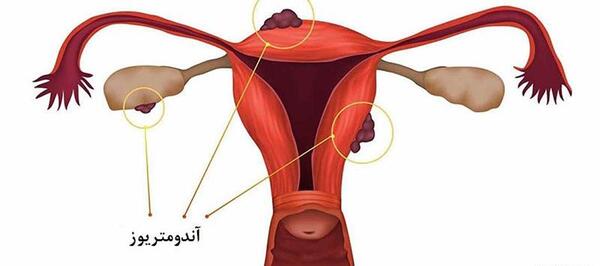 عکس بافت آندومتریوز