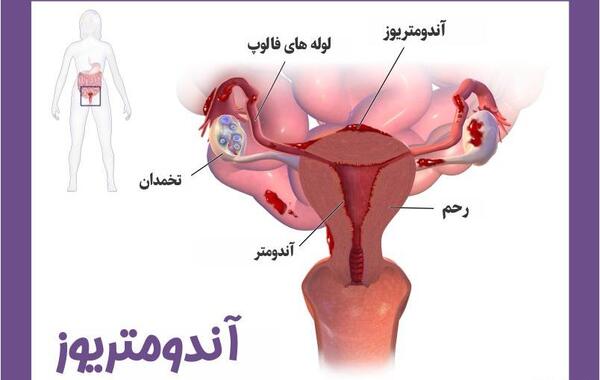 عکس بافت آندومتریوز