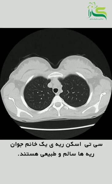 عکس سه بعدی ریه