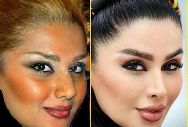 عکس دنیا جهانبخت قبل و بعد از عمل