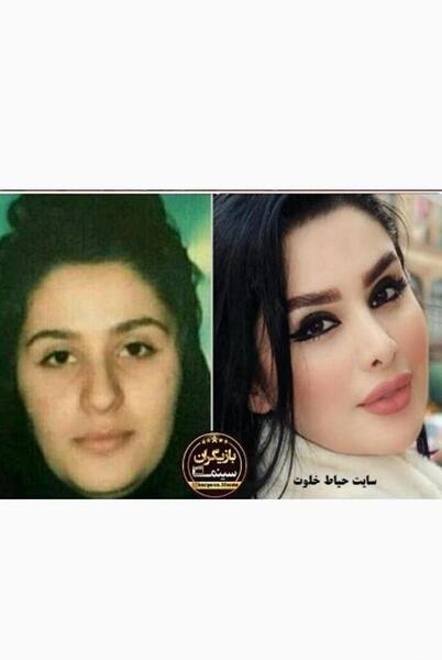 عکس دنیا جهانبخت قبل و بعد از عمل