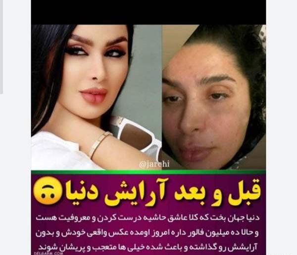 عکس دنیا جهانبخت قبل و بعد از عمل