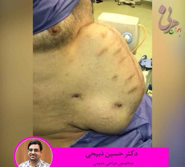 عکس شکم کبود شده