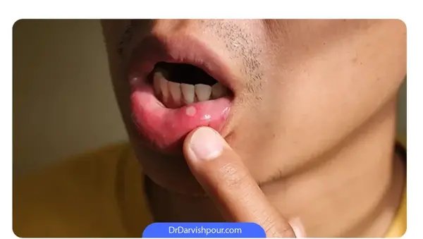 عکس ضایعات زیر زبان