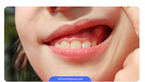 عکس ضایعات زیر زبان