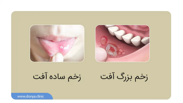 عکس ضایعات زیر زبان