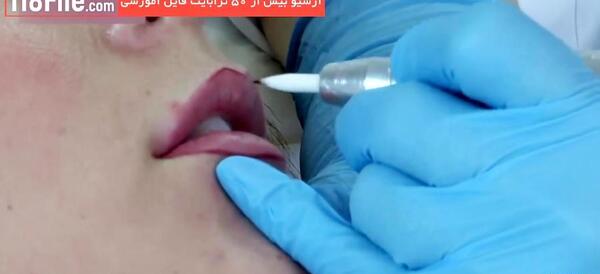عکس لب های پروتز شده