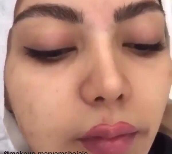 عکس لب های پروتز شده