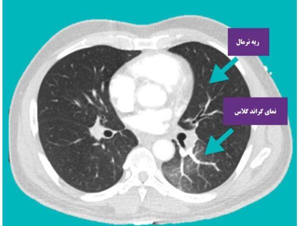عکس ریه افراد کرونایی