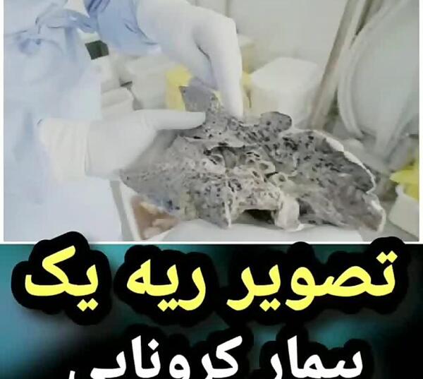 عکس ریه افراد کرونایی