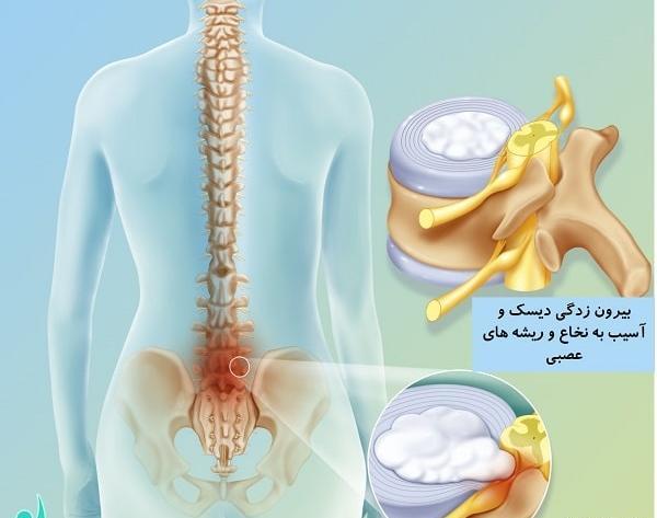عکس کمربند برای دیسک کمر