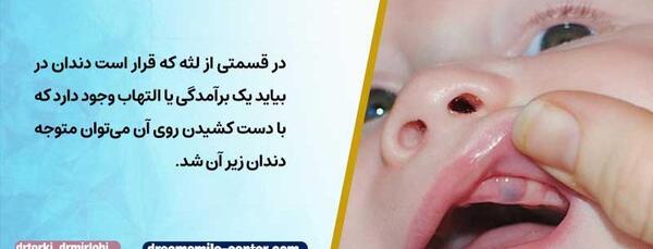 عکس لثه نوزاد هنگام دندان دراوردن