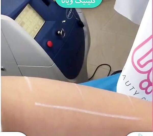 عکس دستگاه لیزر نابلکس