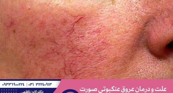 عکس صورت عنکبوتی