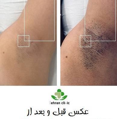 عکس لیزر موهای زائد