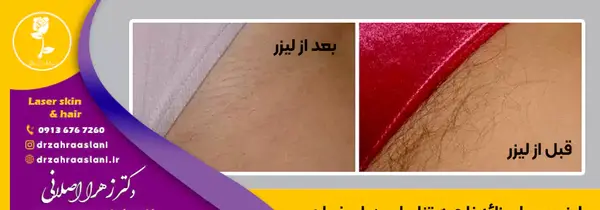 عکس لیزر موهای زائد