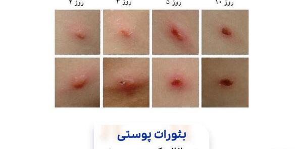 عکس بثورات ابله میمون