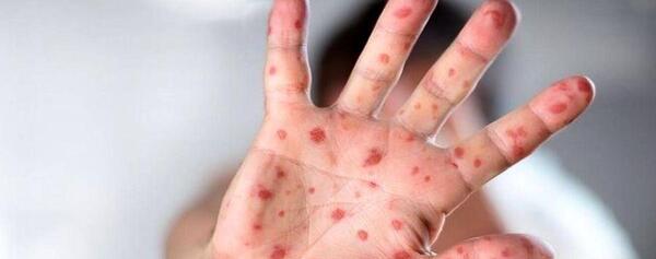 عکس بثورات ابله میمون