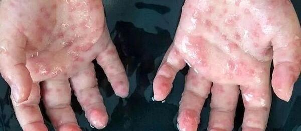 عکس بثورات ابله میمون