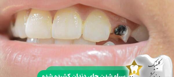 عکس سفید شدن لثه