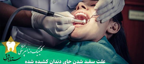 عکس سفید شدن لثه