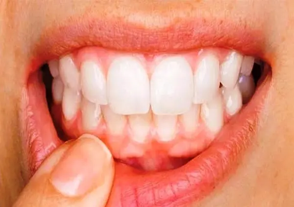 عکس سفید شدن لثه