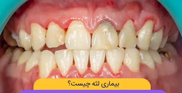 عکس سفید شدن لثه