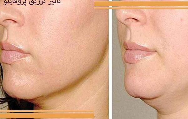 عکس قبل و بعد تزریق پروفایلو