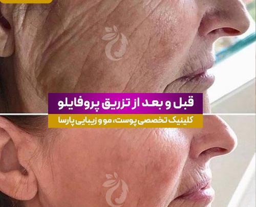 عکس قبل و بعد تزریق پروفایلو