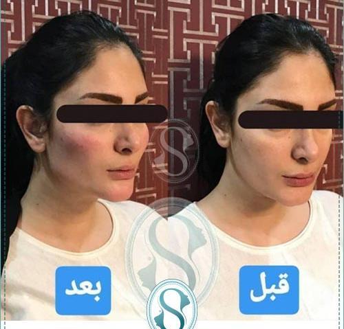 عکس قبل و بعد تزریق پروفایلو