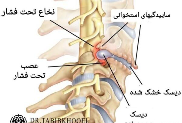 عکس ورزش دیسک گردن