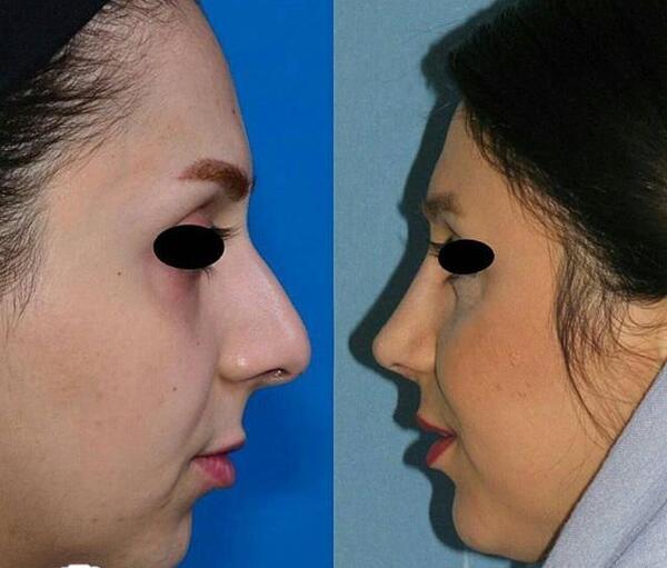 عکس قبل جراحی زلیخا