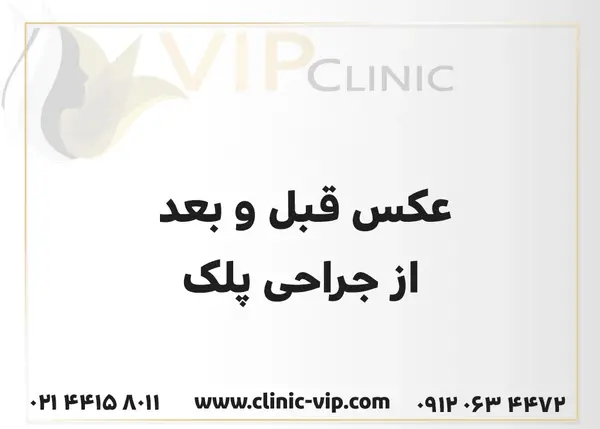عکس قبل جراحی زلیخا