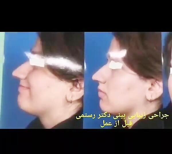 عکس قبل جراحی زلیخا