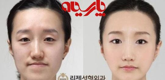 عکس سوسانو قبل از عمل