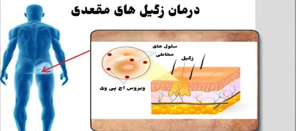 عکس ویروس اچ پی وی