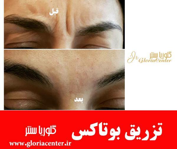 عکس بوتاکس صورت