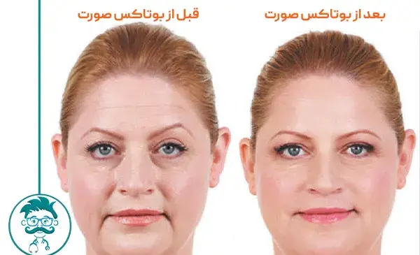 عکس بوتاکس صورت